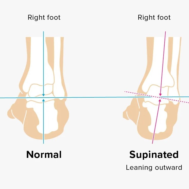 supination running shoes
